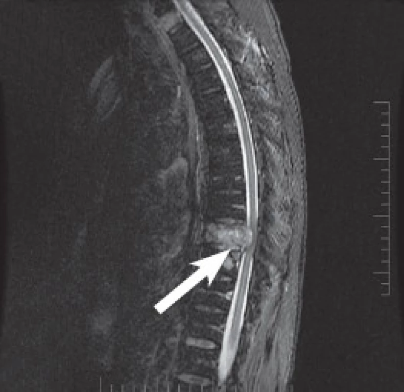 MRI páteře potvrzuje nádorovou infiltraci obratlového těla Th9 se zúžením páteřního kanálu a míšní kompresi.
