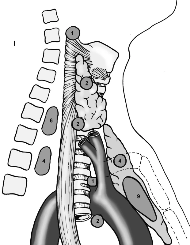 Přehled lokalizací patologické tkáně paratyreoidey při reoperacích.
Pic. 2. Overview of locations of the parathyroid pathological tissue during reoperations