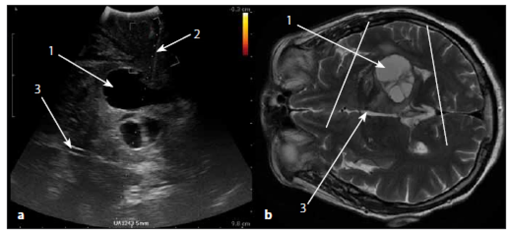 Sonografický obraz glioblastomu thalamu a korespondující MR obraz v T2W vážení.
Fig. 6. The ultrasound image of thalamic glioblastoma and corresponding MRI T2W image.