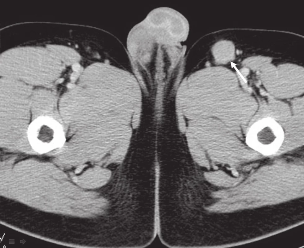 CT břicha, pánve, třísel: patologická lymfatická uzlina levého třísla.