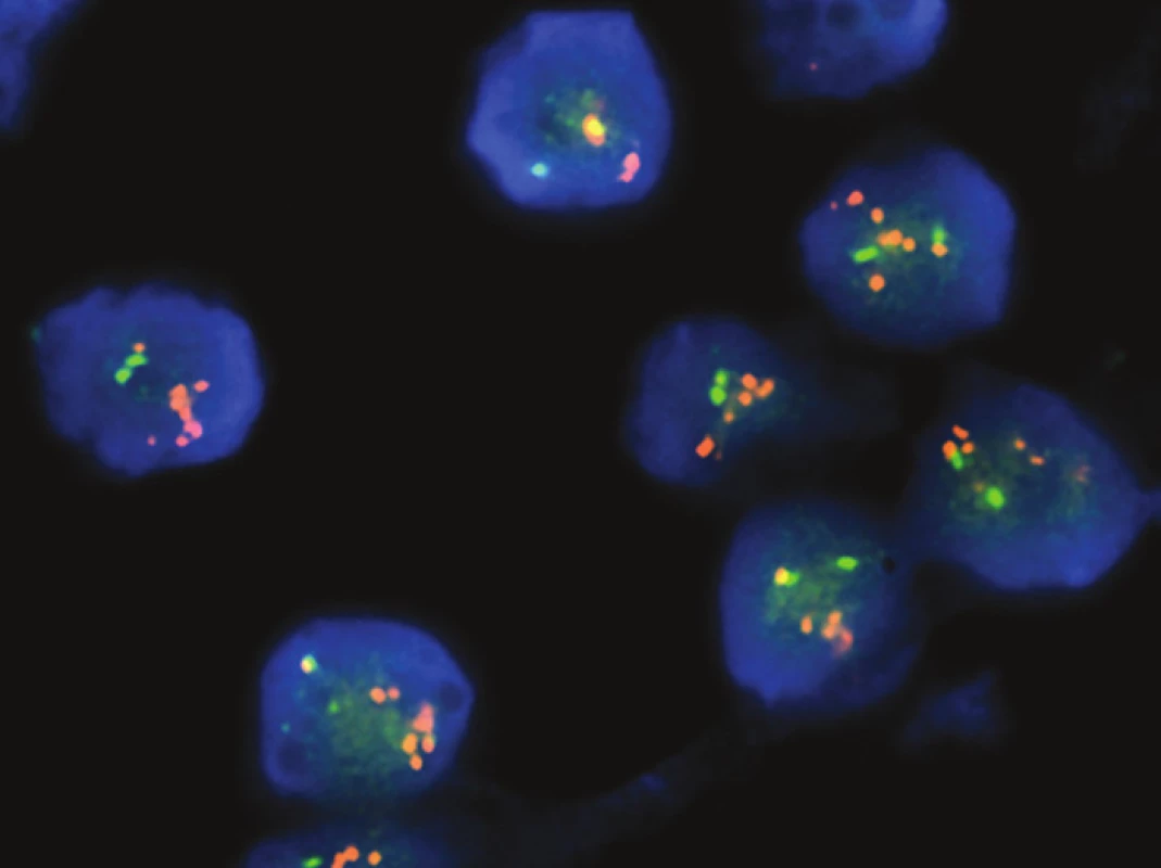 A. Totožná solidní mozaikovitá úprava obou nádorů s bohatou kapilární vaskularizací vytvářející dojem organoidního „neuroendokrinního“ uspořádání (HE, 200x). B. Nakupení četných drobných hnízd kulatých pravidelných buněk s výrazně světlou cytoplazmou a difúzní hojnou příměsí eozinofilních leukocytů (HE, 400x). C. Difúzní, silná membránová exprese antigenu CD99 v nádorových elementech (imunohistochemie). D. Pozitivní FISH analýza zlomu genu EWSR1 s amplifikací proximálně situované části sondy - červené signály (EWSR1 break apart probe, AbbottMolecular).