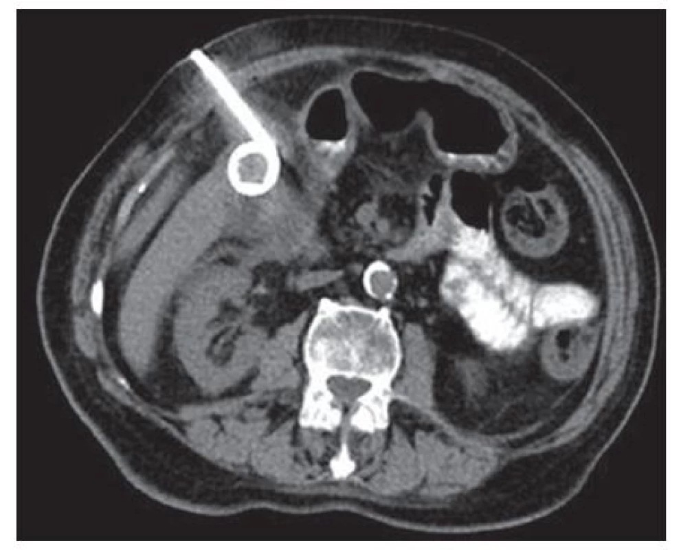 Transabdominální perkutánní drenáž žlučníku
Fig. 5: Percutaneous transabdominal gallbladder drainage