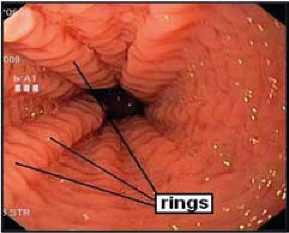 Endoskopický obraz výrazného krepování (rings) sliznice jícnu u pacienta s dg. EoE.
Fig. 3. Endoscopic image of significant rings of the esophageal mucosa in a patient with EoE.