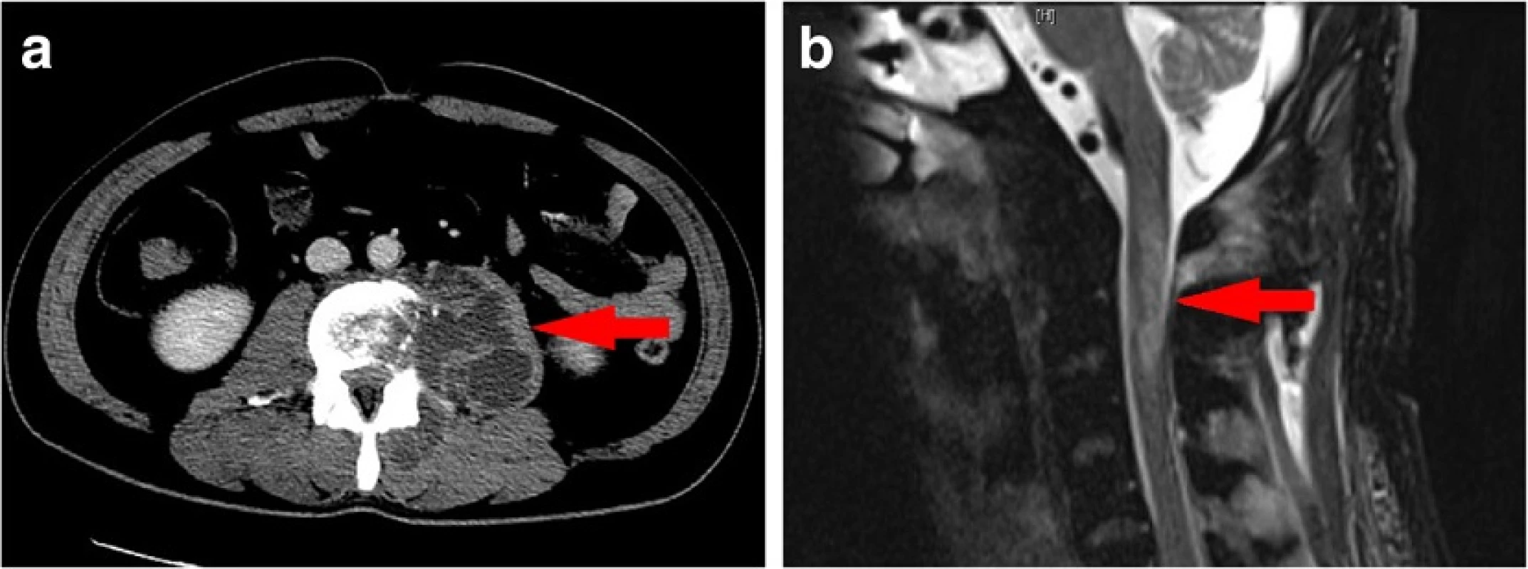 A psoas abscess and its remote involvement. a Ring enhancement in the left psoas muscle on an enhanced CT image obtained on the day of admission. b The cervical MRI findings revealed altered signal intensity involving C2-3, with cord expansion on T2-weighted sagittal sections, suggestive of myelitis