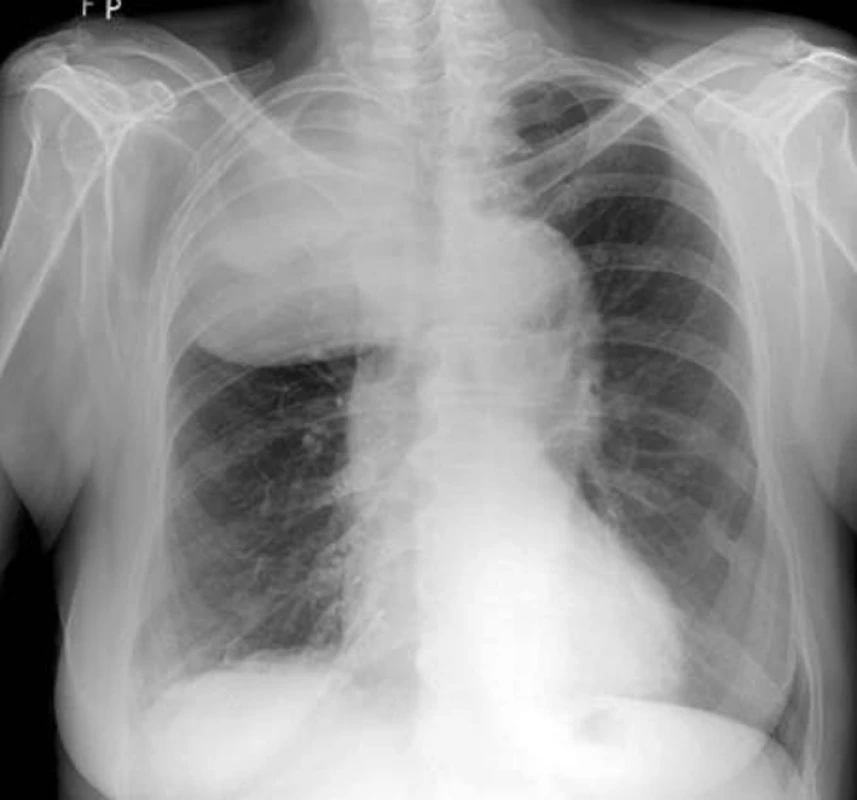 RTG – špatně diferencovaný sarkom v oblasti horního a částečně i středního plicního pole pravé plíce.