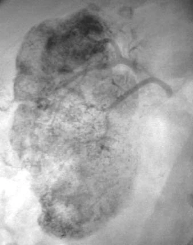 Nativní snímek pravé ledviny po embolizaci