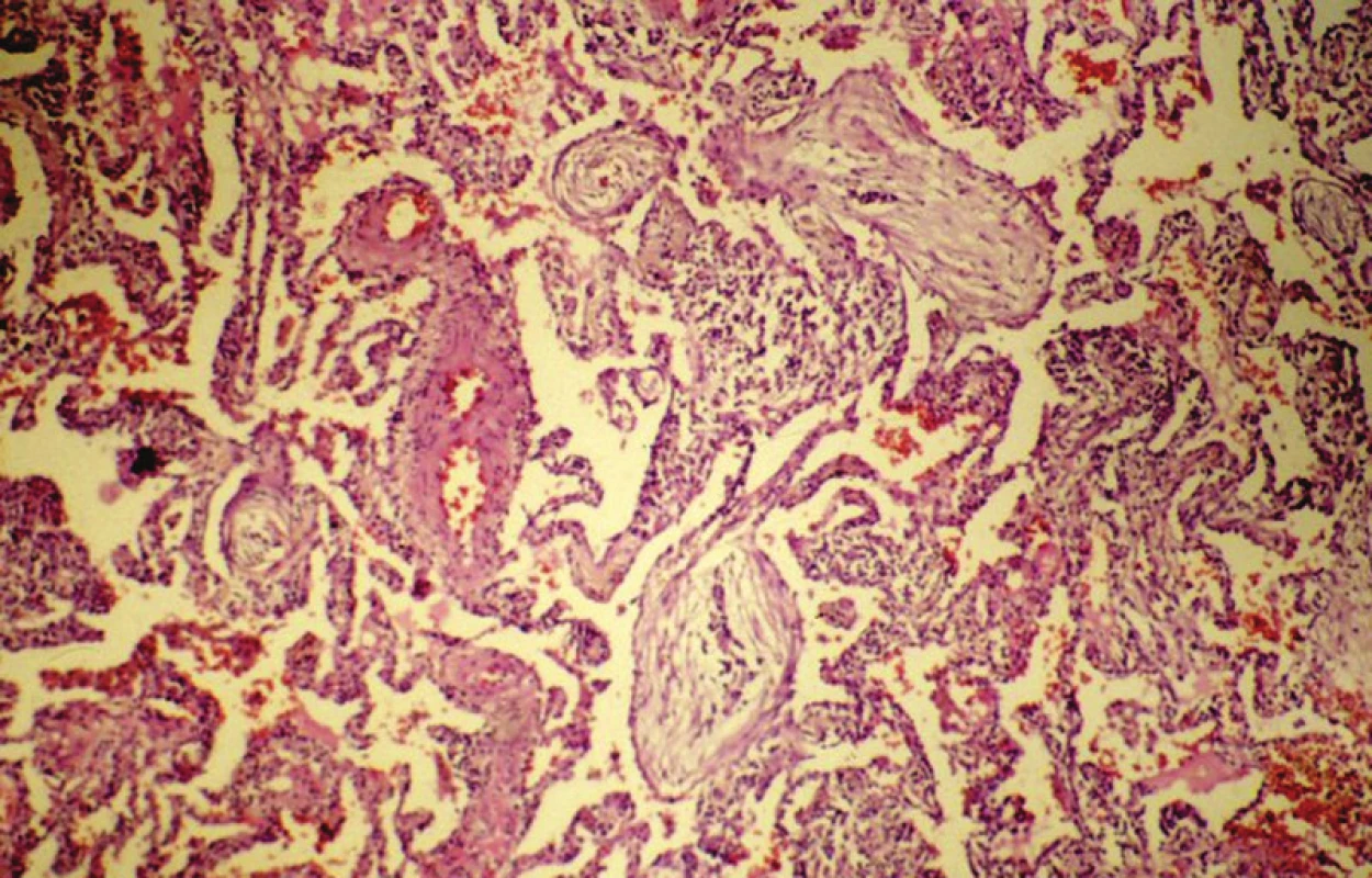 Organizující se pneumonii charakterizuje nález intraalveolárních vazivových Massonových tělísek. HE, 120krát