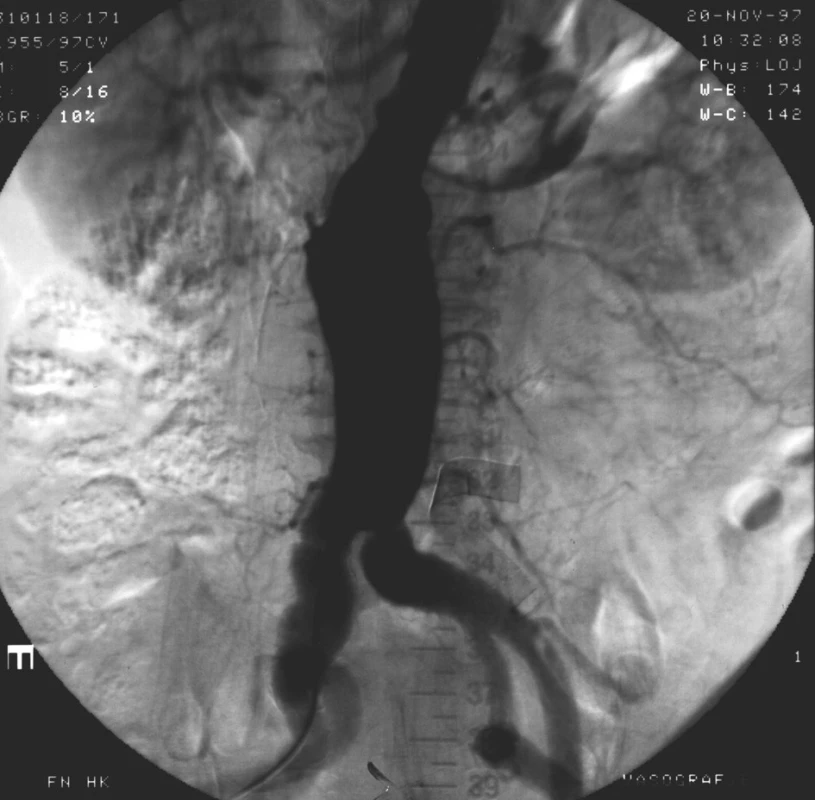 Angiografický nález bezprostředně po zavedení aorto-uniiliakálního stentgraftu
Fig. 1. Angiographic image immediate after implantation of aortouniiliac stentgraft