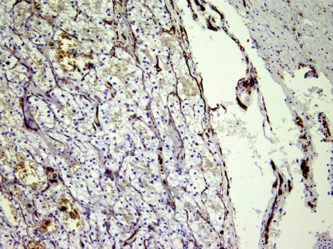 Povrch trombu je kryt endotelem, což je důkaz přítomnosti nádorové tkáně v cévě, CD 34, 200x
Fig. 2. The thrombus surface is covered by endothelium, providing the evidence of the neoplastic tissue presence in the vein, CD 34, 200x