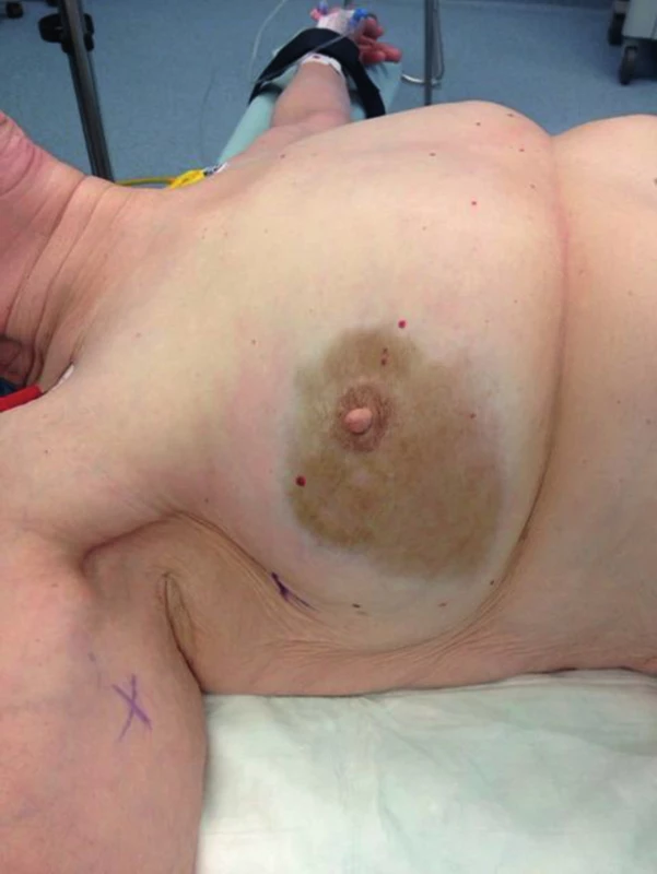 Hnědavě zbarvená skvrna na prsu po aplikaci Sienny
Fig. 5: Brownish-colored area of the breast following Sienna+ injection