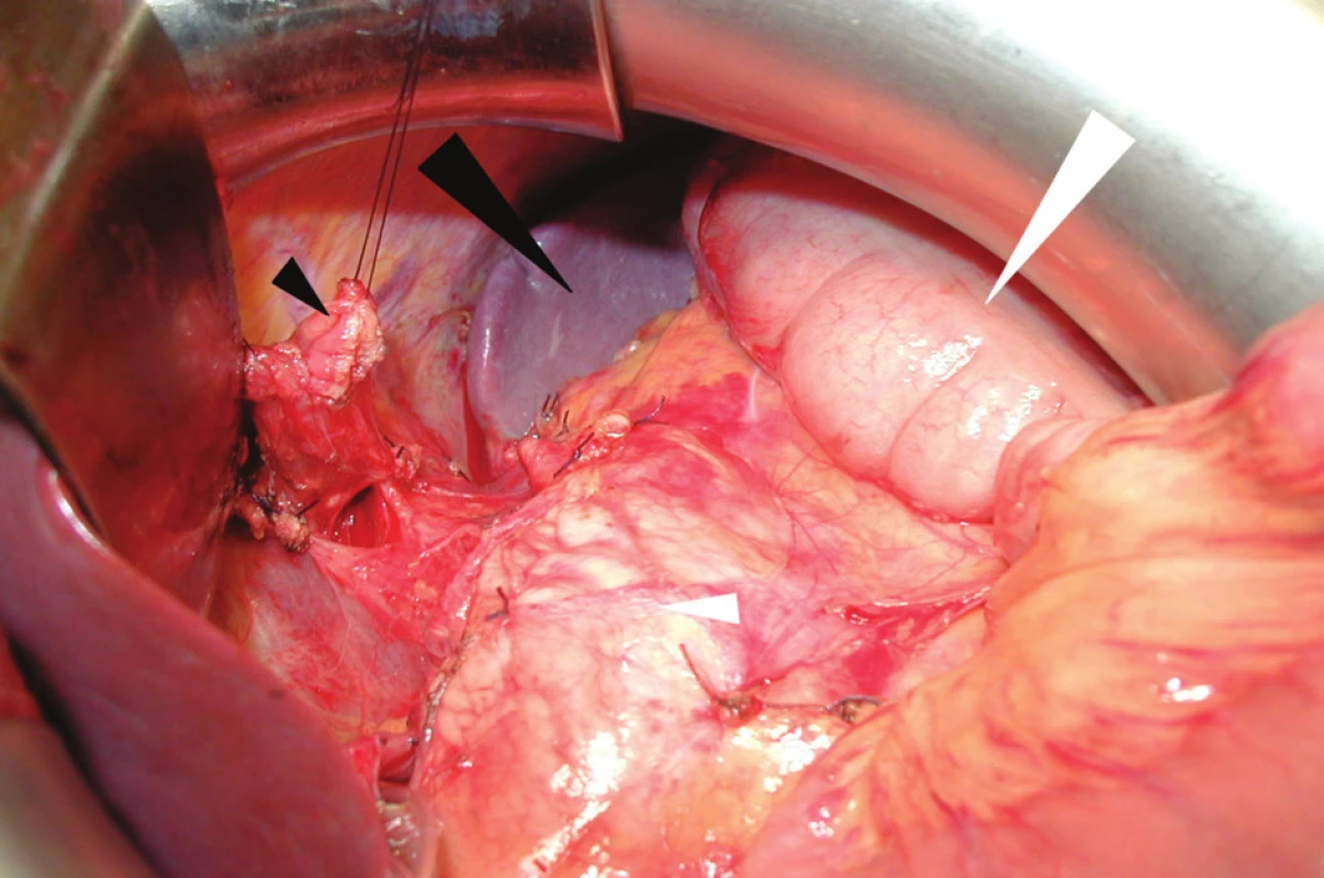 Operační nález po dokončení resekční fáze výkonu: na spodině je tkáň pankreatu (malá bílá šipka), lienální ohbí tračníku (velká bílá šipka), slezina (velká černá šipka) a na závěsném stehu přerušený abdominální jícen (malá černá šipka)