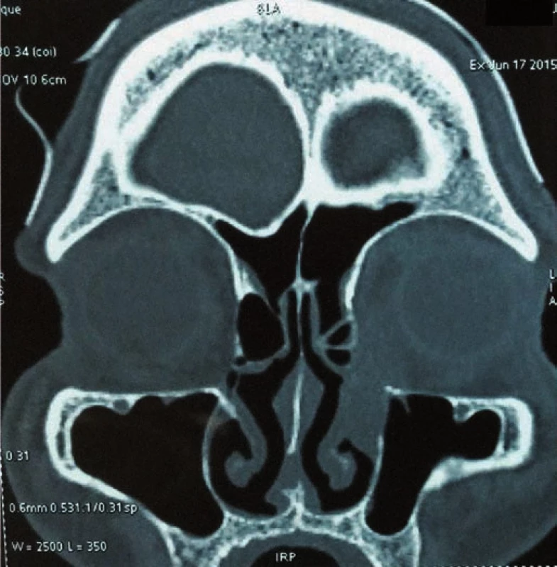 CT scan showing heterogeneous irregular non-calcified mass approximately 2.3–2.6 cm in size with extension into the nasolacrimal duct.