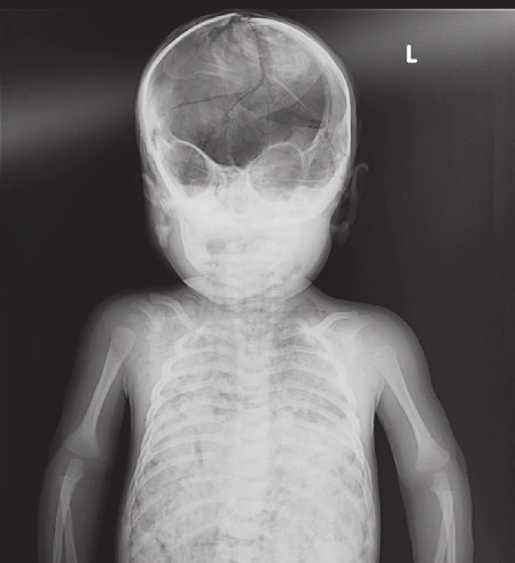 RTG snímek hlavy a hrudníku: zlomenina klenby lební u 3 měsíčního kojence (vražda – utlučení otcem).