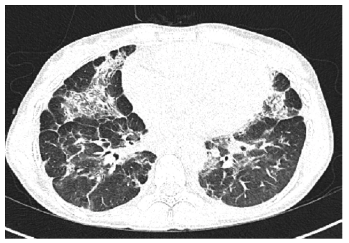 HRCT plic, transverzální sken, plicní okno – kontrolní
vyšetření (6 měsíců po 2. cyklu): další regrese konsolidací, dnes
spíše cárovité změny bilaterálně, denzity mléčného skla, bez
výraznějších plicních konsolidací<br>
Figure 5. HRCT of the lungs, transverse scan, lung window:
control examination (6 months after 2nd cycle): further
consolidation regression, nowadays rather cvaric changes
bilaterally, density of milk glass, no more significant pulmonary
consolidation