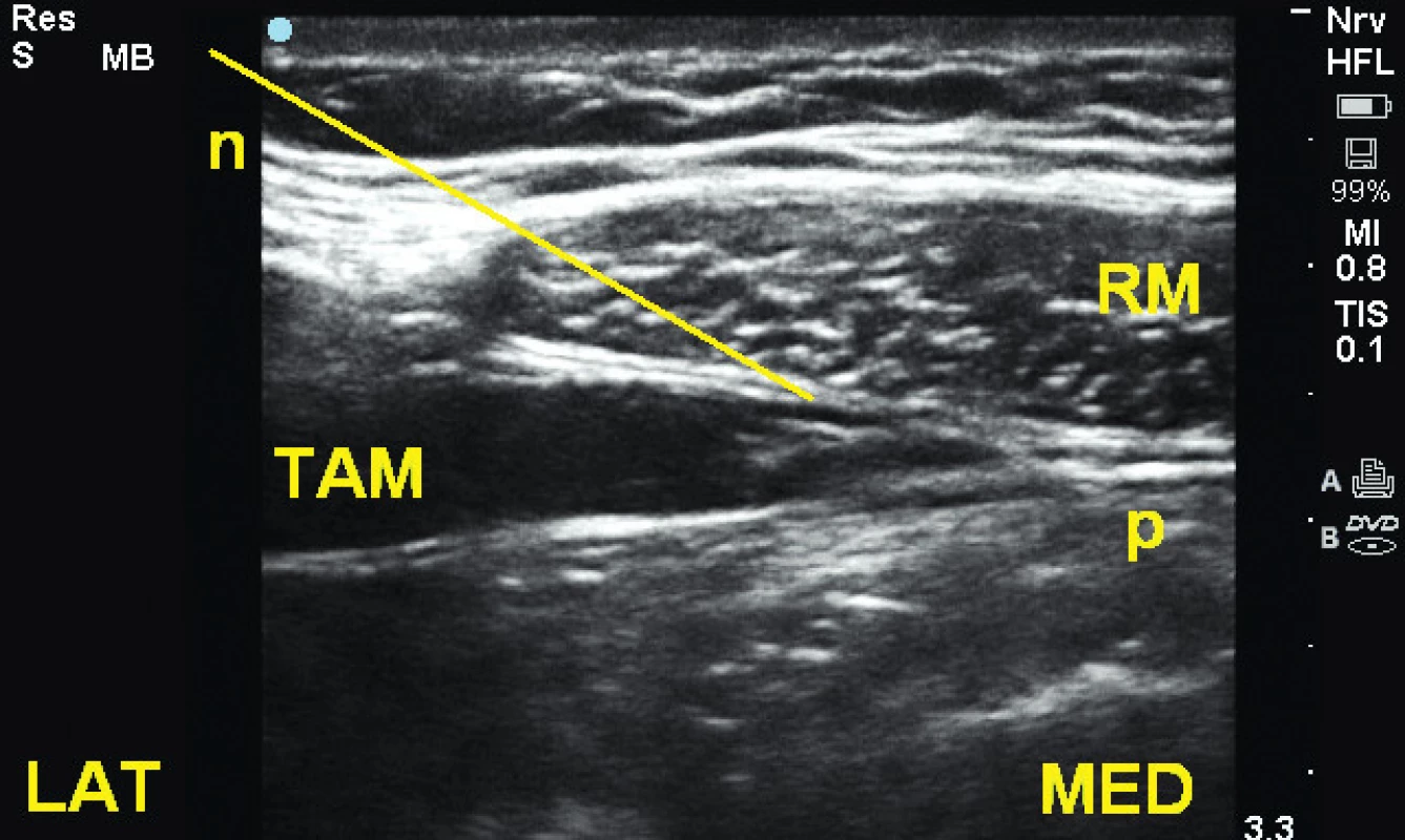 Rovina mezi m. transversus abdominis a m. rectus (TRAP) v subkostální oblasti TAM – m. transversus abdominis, RM – m. rectus abdominis, n – jehla
