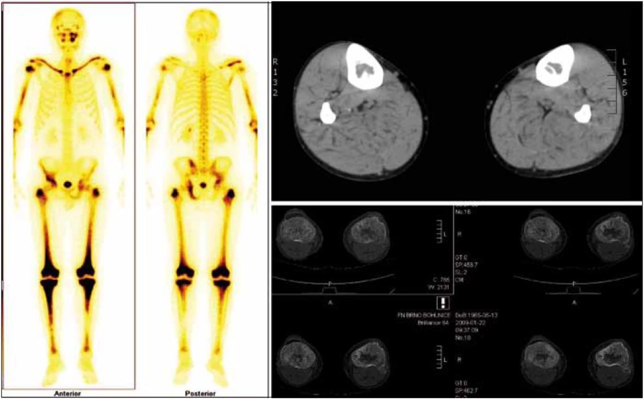 Erdheimova-Chesterova nemoc – infiltrace pěnitých histiocytů v dlouhých kostech způsobuje reaktivní hyperostózu se zvýšeným ukládáním Ca, ale i Techneciapyrofosfonátu v kompaktě dlouhých kostí. Zesílení bércových kostní je zřetelné na CT snímcích. Cytokiny, produkované těmito buňkami, způsobují pak další projevy v oblasti břicha i hrudníku.