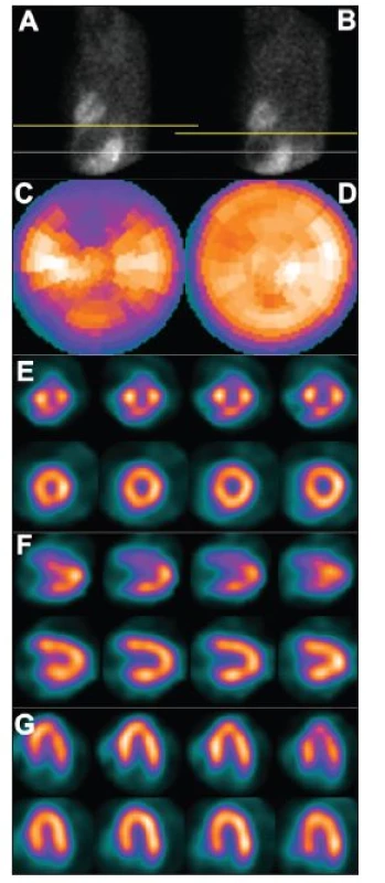 Vertikální pohyb srdce v průběhu snímání – dva po sobě jdou snímky tomografického záznamu (A – před pohybem, B – po pohybu), žlutá čára vyznačuje rozsah pohybu. Pohyb pacienta v průběhu snímání vede k arteficiálním defektům perfuze – zobrazení na polární mapě (C) a vybraných tomografických řezech (horní řady E – SA, F – VLA, G – HLA). U opakované studie, již bez pohybu pacienta, jsou defekty perfuze výrazně menší – zobrazení na polární mapě (D) a vybraných tomografických řezech (dolní řady E – SA, F – VLA, G – HLA).