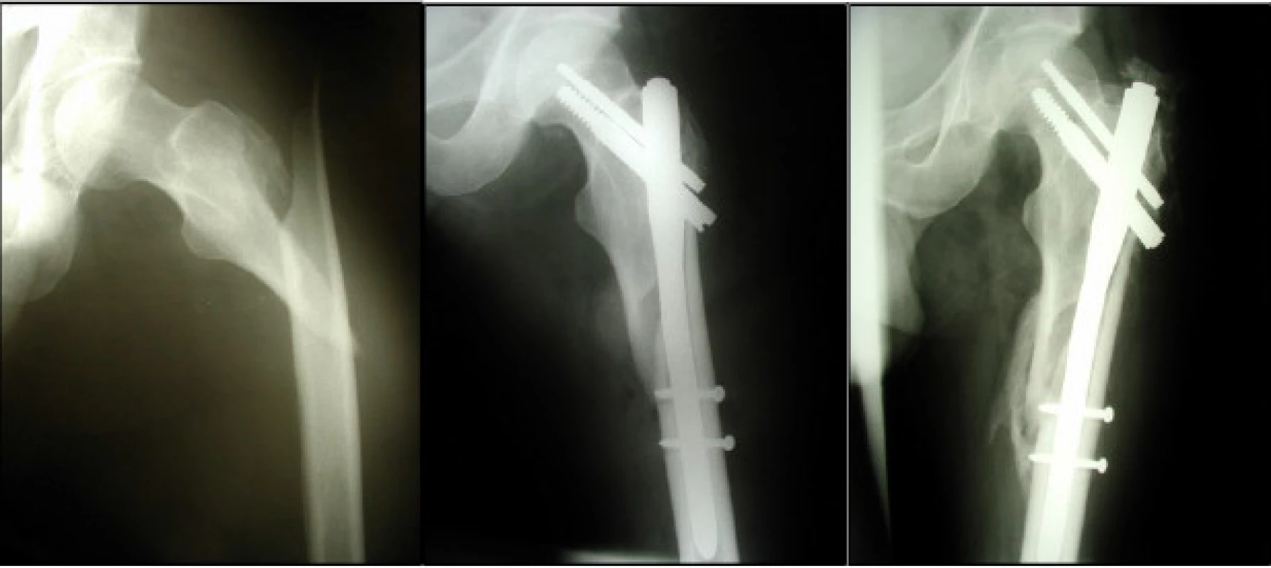 Pacient, 43 let, s nízkou subtrochanterickou zlomeninou vlevo (a), chybně indikovaný krátký hřeb, použit krátký nosný šroub (b), kontrolní snímek za 12 týdnů (c).