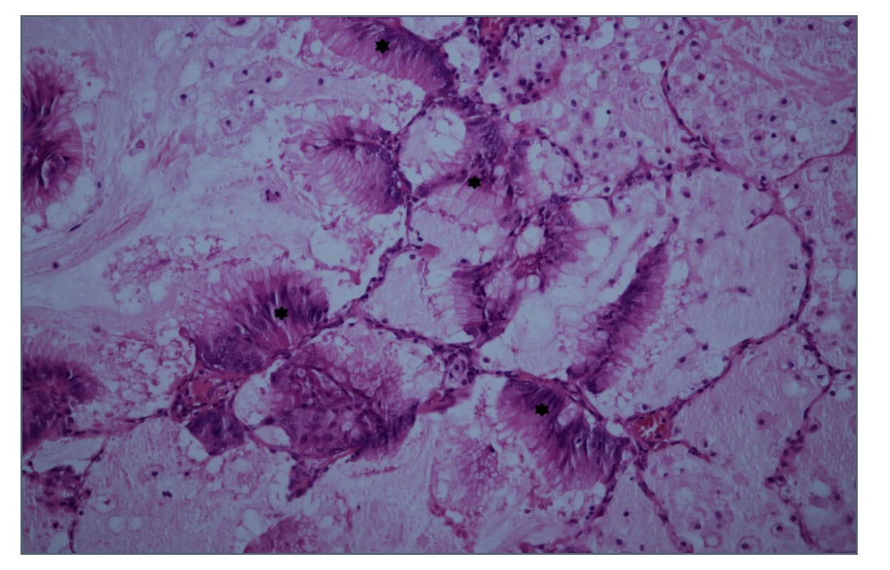 Histologický řez ložiskem v pravé plíci, hematoxylin-
eosin<br>
Hvězdičky označují ložiska tumoru.<br>
Fig. 5: Biopsy section of the right lung focus, HE staining<br>
Stars indicate the tumour foci.
