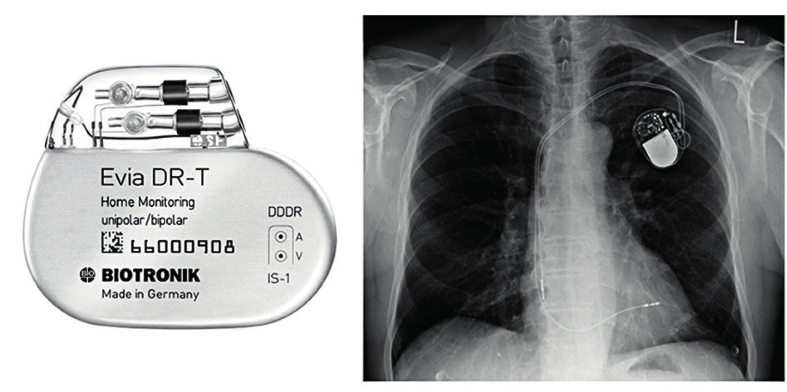 Příklad dvoudutinového kardiostimulátoru a prostý RTG snímek hrudníku zachycující voperovaný přístroj a dvě elektrody (jedna v pravé síni, druhá v pravé komoře)