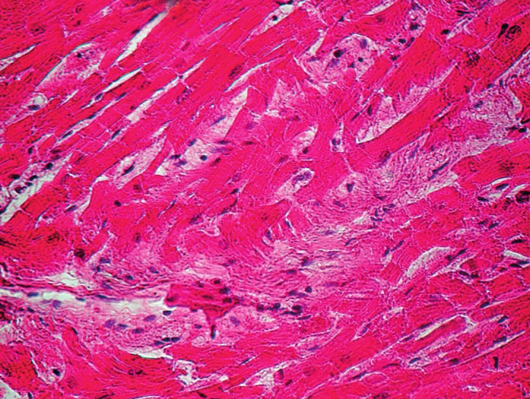 Hypertofie a disarray kardiomyocytů v levé komoře srdeční, v centrální části jsou patrná ložiska intersticiální myofibrosy, barvení H-E, zvětšení 400x.