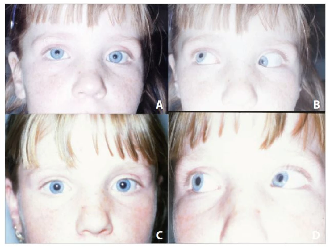 &lt;b&gt;Léčba betamethasonem.&lt;/b&gt; A – akutní Brownův syndrom vlevo u fixujícího oka, sekundární hypertropie vpravo, B – syndrom „cvaknutí“ horního šikmého svalu vlevo, C – paralelní postavení očí po aplikaci léku, D – následné vyrovnání motility v addukci vlevo