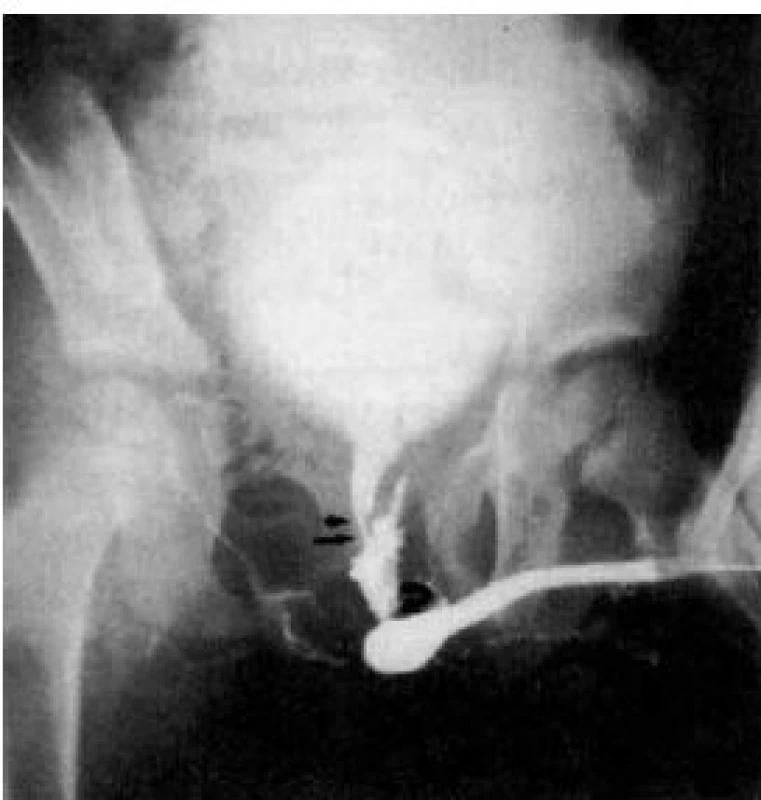Ascendentní uretrocystografie u parciální ruptura membranózní uretry
Fig. 4. Ascendent urethrocystography in partial rupture of the membranous urethra