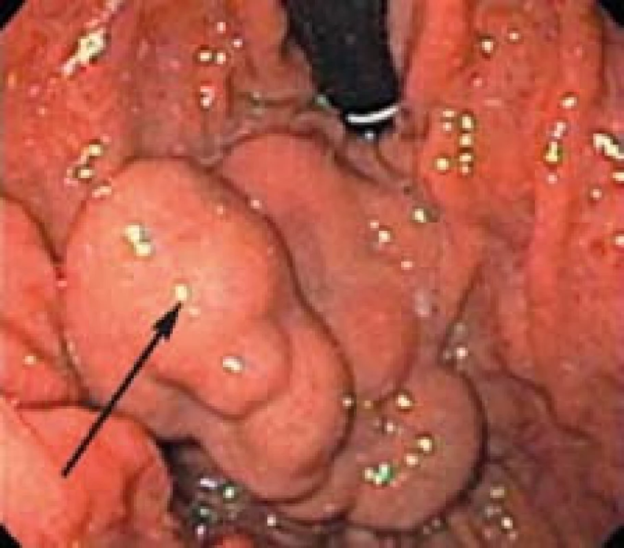 Gastrické varixy pri endoskopickom vyšetrení horného tráviaceho traktu [22].
Fig. 3. Gastric varices by endoscopic examination of the upper gastrointestinal tract [22].