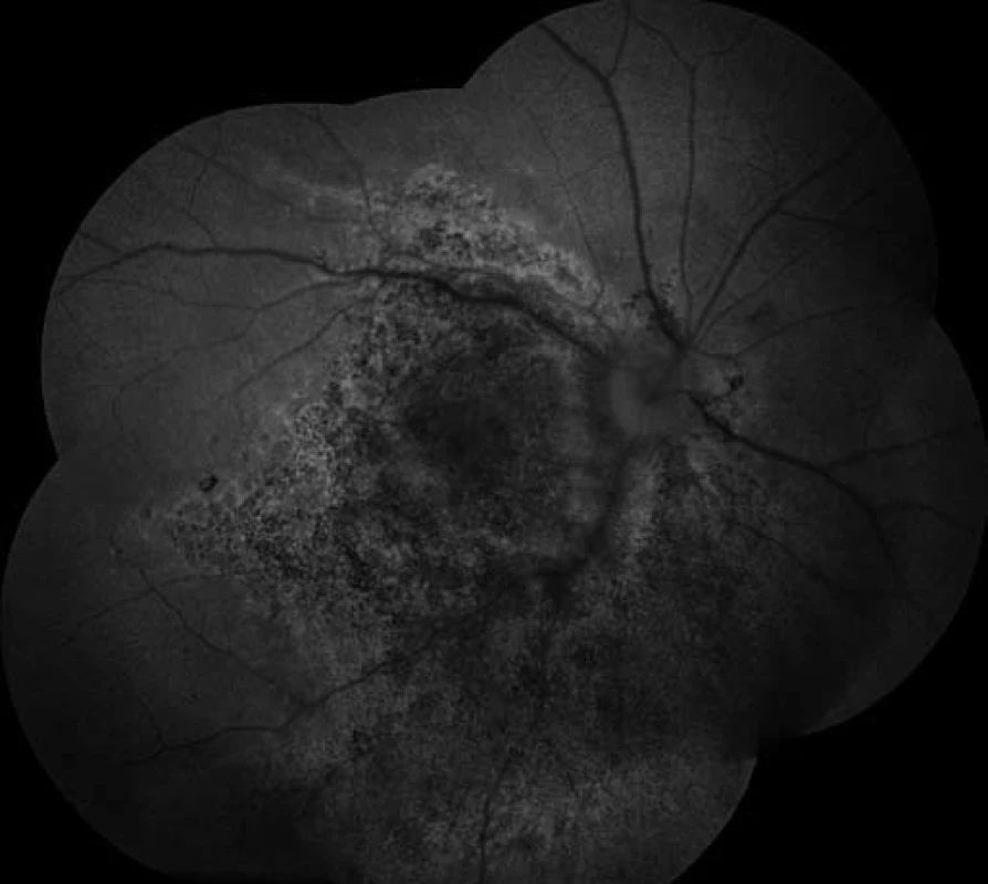 Auto-fluorescenční fotografie očního pozadí oka pravého po 5 týdnech po zahájení léčby Valcyte. Atrofie sítnice včetně centrální krajiny – hrubé dysgrupace pigmentu v postižené oblasti.