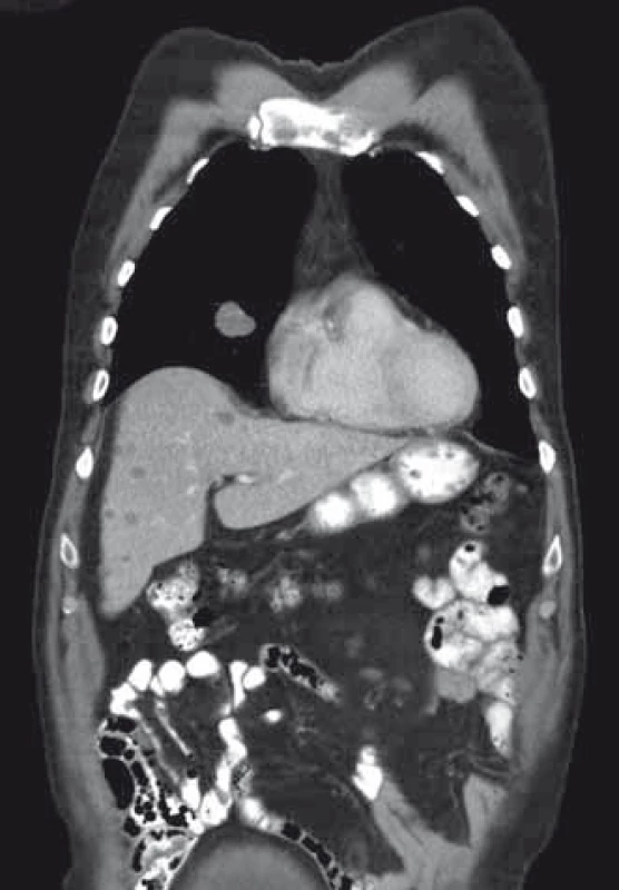 CT s obrazem jaterních metastáz a plicní metastáza v pravém středním plicním laloku.
Fig. 8. CT scan showing liver metastases and a lung metastasis in the right middle lobe of the lung.