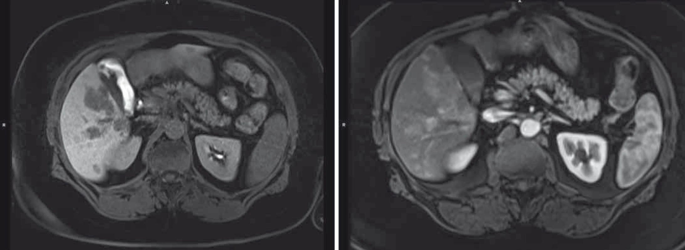 Velikostní a početní progrese jaterního postižení dle MRI.