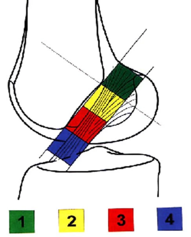 Konstrukce možných poloh femorálního kanálu v sagitální rovině
