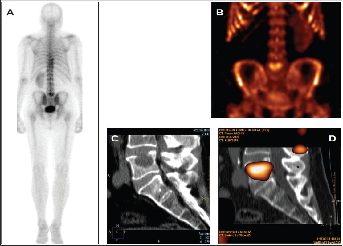 Osteolytická metastáza karcinomu plic do 5. bederního obratle.
