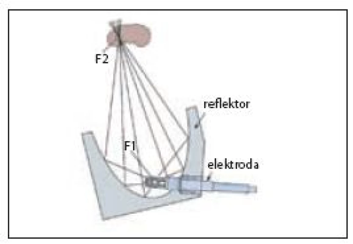Elektrohydraulický princip generování rázové vlny
Fig. 5 Electrohydraulic shock wave generator