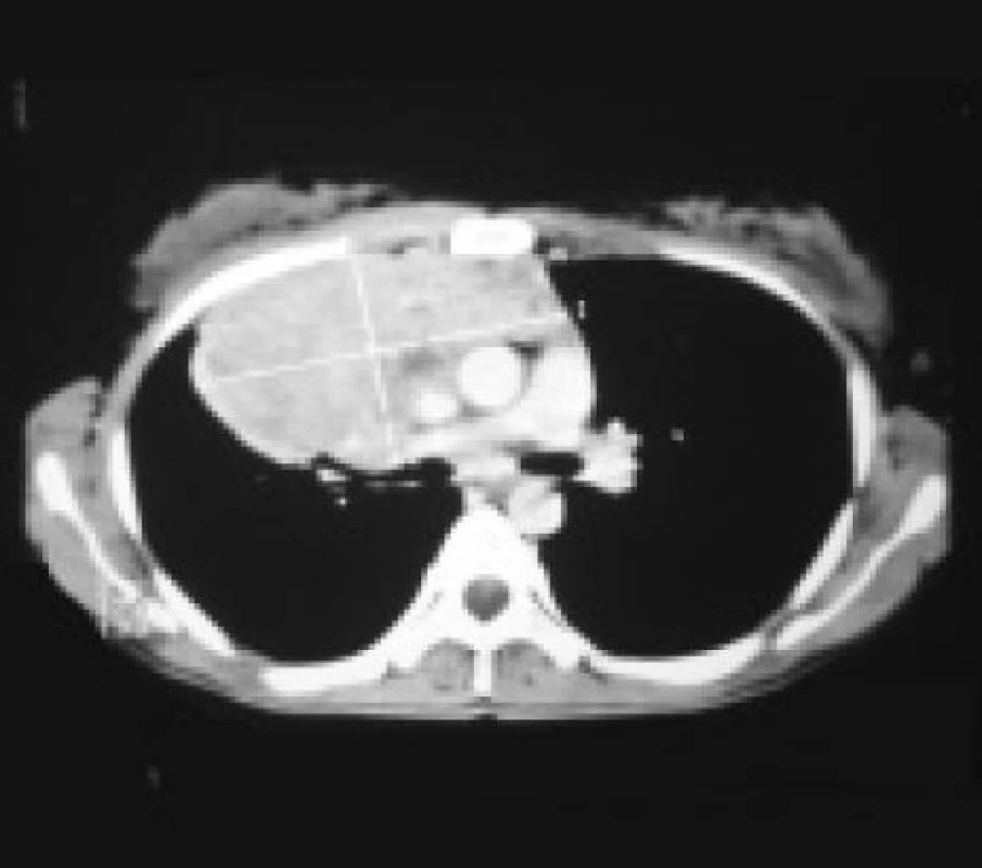 RTG snímek plic a CT zobrazení hrudníku u mladé ženy s patologickým expanzivním útvarem v mediastinu.