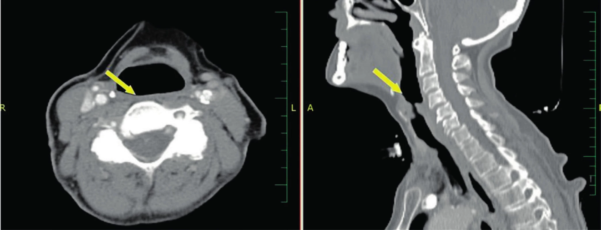 CT snímky s kontrastem - šipka ukazuje na oblast supraglotis 1 rok po TORS.