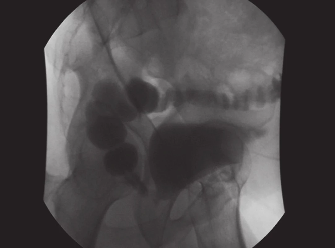 Cystografie s průkazem rektovezikální píštěle
Fig. 3. Cystography with the rectovesical fistula