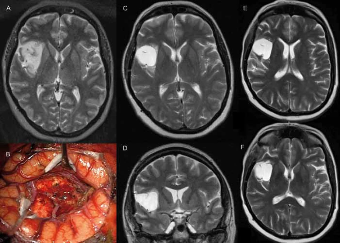 A) předoperační T2W MRI pacientky s insulárním nízkostupňovým gliomem vpravo typu dle Yaşagila 3A. B) intraoperační fotografie, dokumentující technickou náročnost resekcí nádorů v insule (operkulum, větvení arteria cerebri media). C, D) T2W MRI zobrazující residuum nádoru v oblasti horního periinsulárního sulku, v přední a zadní části insuly. E, F) T2W MRI po kombinované chemoradioterapii s dobrou reakcí a regresí T2 hyperintenzity.