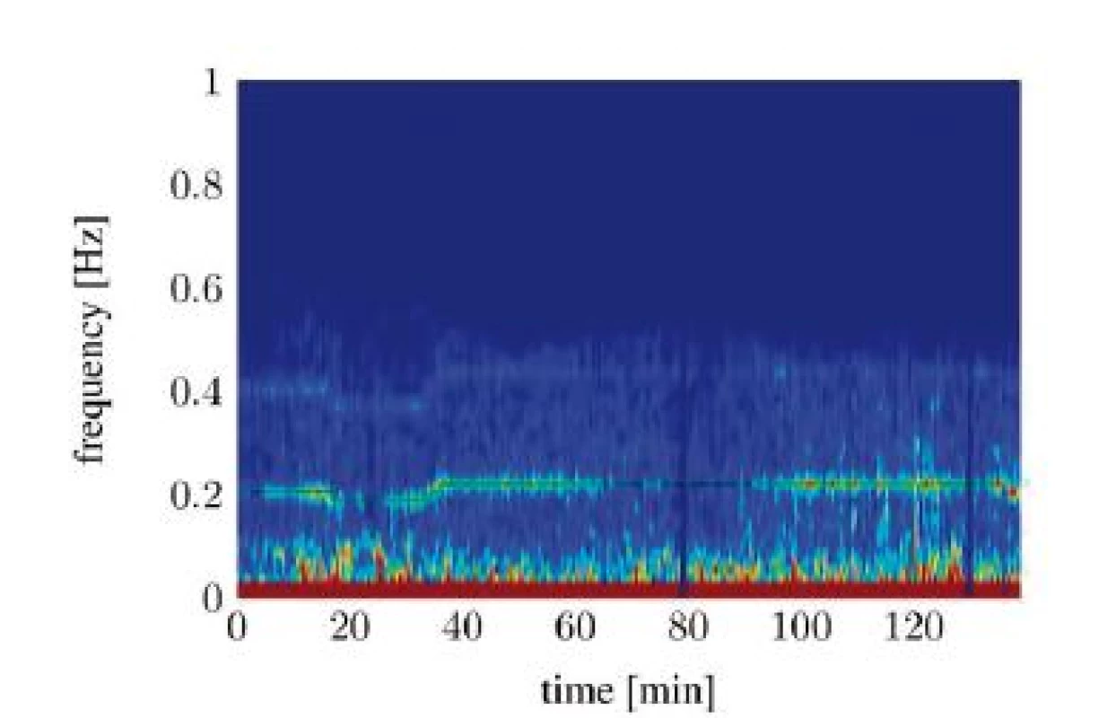 Spectral signal representation of the heart rate variability trough short time Fourier transforms (tA10).
