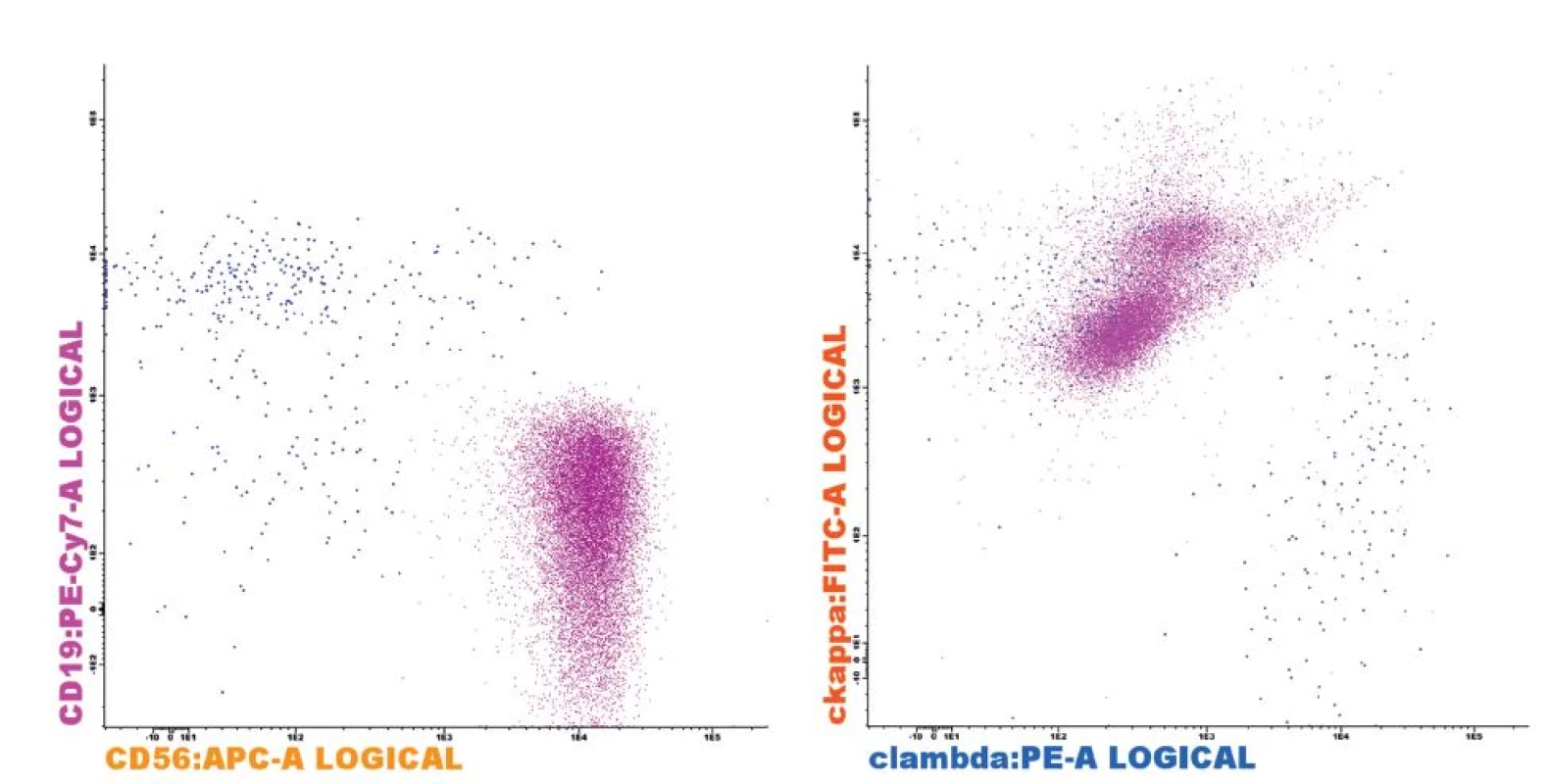 Fenotyp plazmocytů (PC) u pacienta s MM
Patologické klonální PC (fialová) s typickým fenotypem CD19-CD56+ (A) a restrikcí cytoplazmatického lehkého imunoglobulinového řetězce kappa (B). Reziduální fyziologické PC (modrá) bez exprese CD56 (A) a normálním poměrem exprese lehkých řetězců kappa/lambda (B). Analýza provedena na flowcytometru FACSCantoII s využitím akvizičního software Diva 6.0 (Becton Dickinson) a analyzačního software Infinicyt 1.6 (Cytognos).