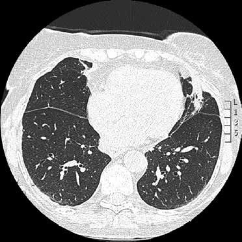 CT hrudníku: atelektáza v levé plíci