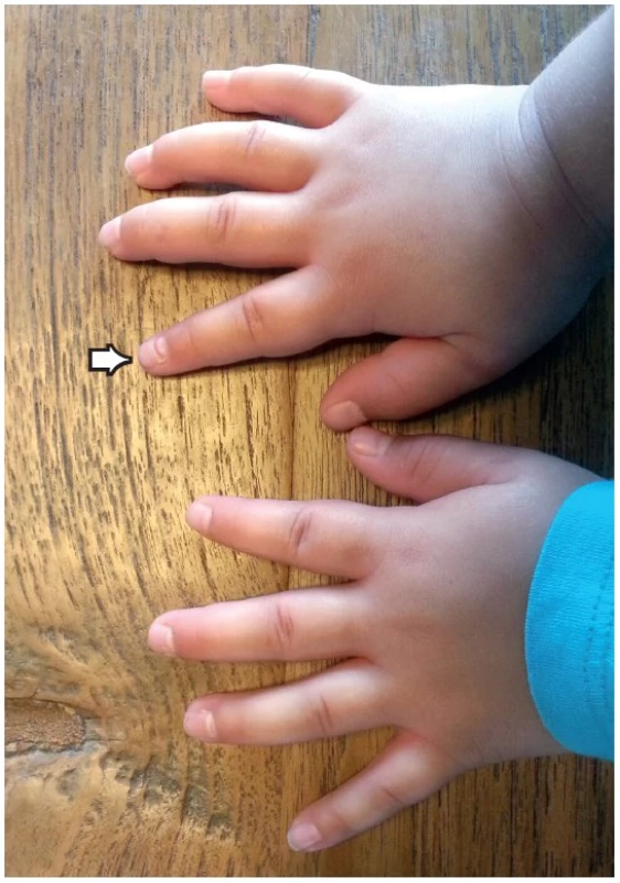Postižení nehtů před onychomadesis – uvolnění od matrix nehtového lůžka.
Fig. 1. The impairment of the nails before shedding – release from the matrix of the nail bed.