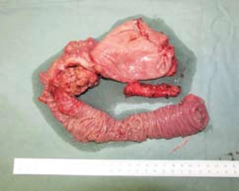 Karcinom hlavy pankreatu – makroskopie resekátu.
Fig. 1. Pancreatic head carcinoma – resected specimen macroscopy.