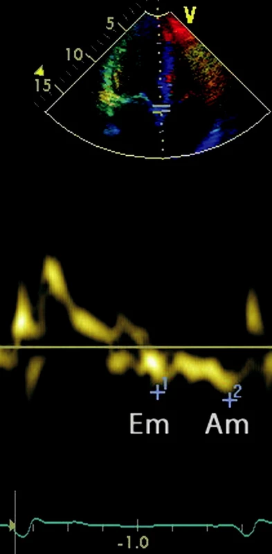 Tkáňový Doppler pohybu mitrálního anulu Em Am.