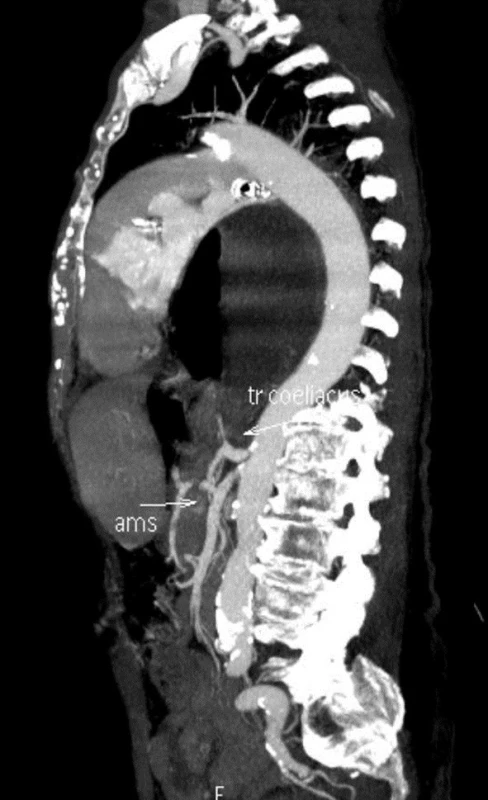 Sagitální CT snímek
Fig. 13: Sagittal CT image

