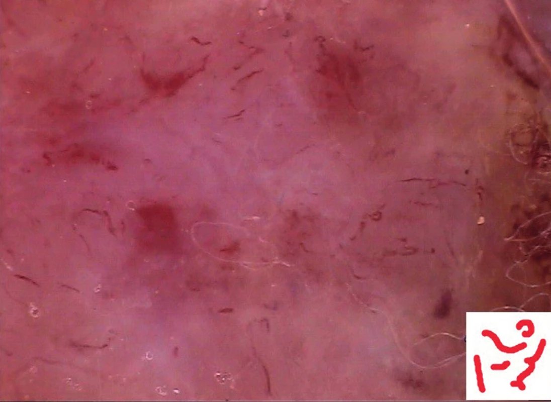 Lineární nepravidelné cévy (maligní melanom)