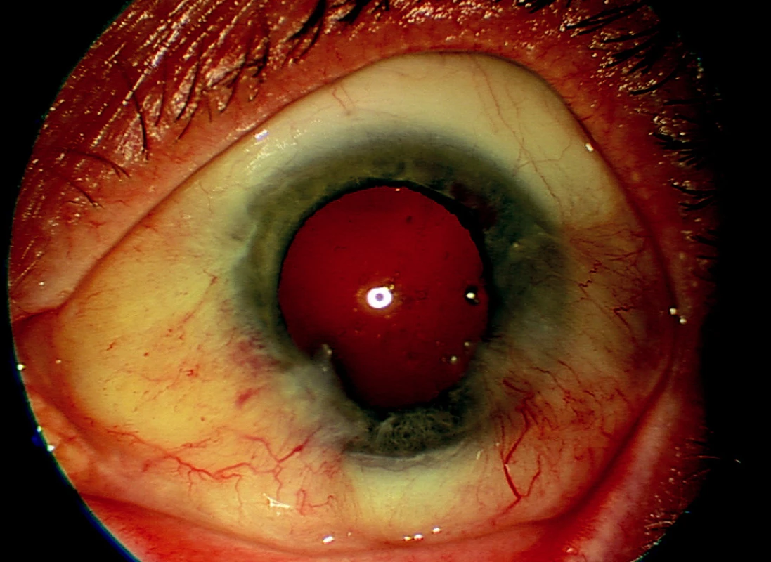 Levé oko – recidiva po 5 operacích