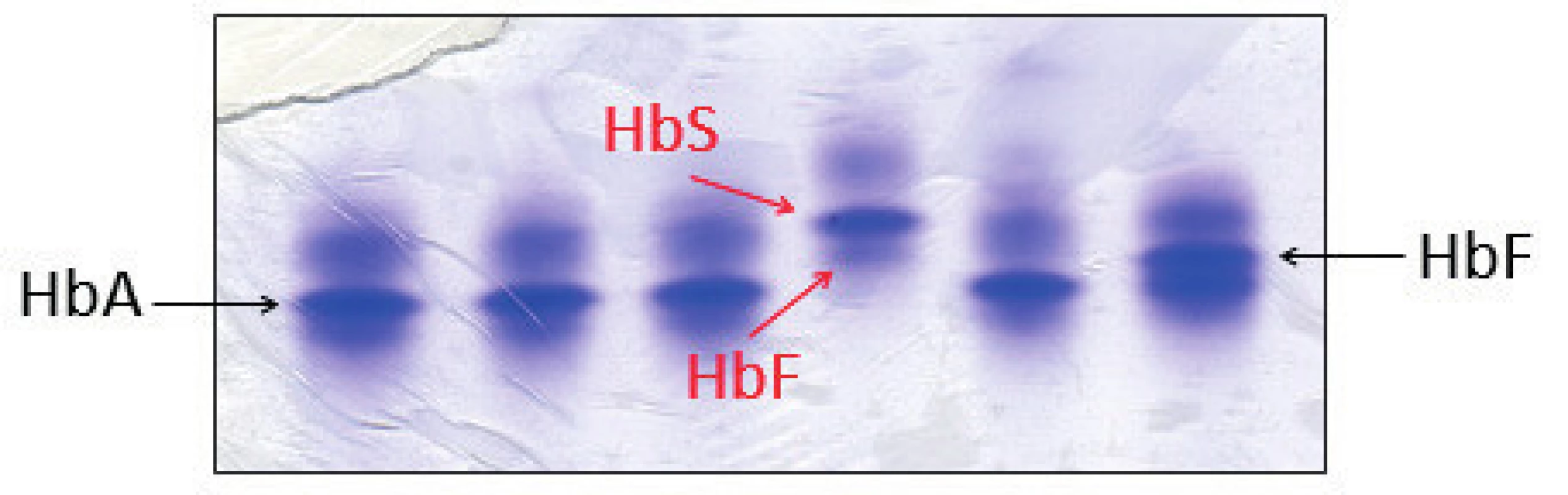 Detekce HbS proteinovou elektroforézou na polyakrylamidovém gelu barveném Coomasie blue. Červené šipky označují frakce HbS a HbF jako jediné hemoglobiny u pacienta se srpkovitou anémií, což odpovídalo zjištěnému genotypu pacienta. (Hemato-onkologická klinika, FN a LF Univerzity Palackého v Olomouci)
Fig. 5. Detection of HbS by protein electrophoresis on polyacrylamid gel stained with Coomasie blue. Red arrows indicate the HbS and HbF fractions as the only hemoglobins in a patient with sickle cell disease, which corresponds with patient’s genotype.