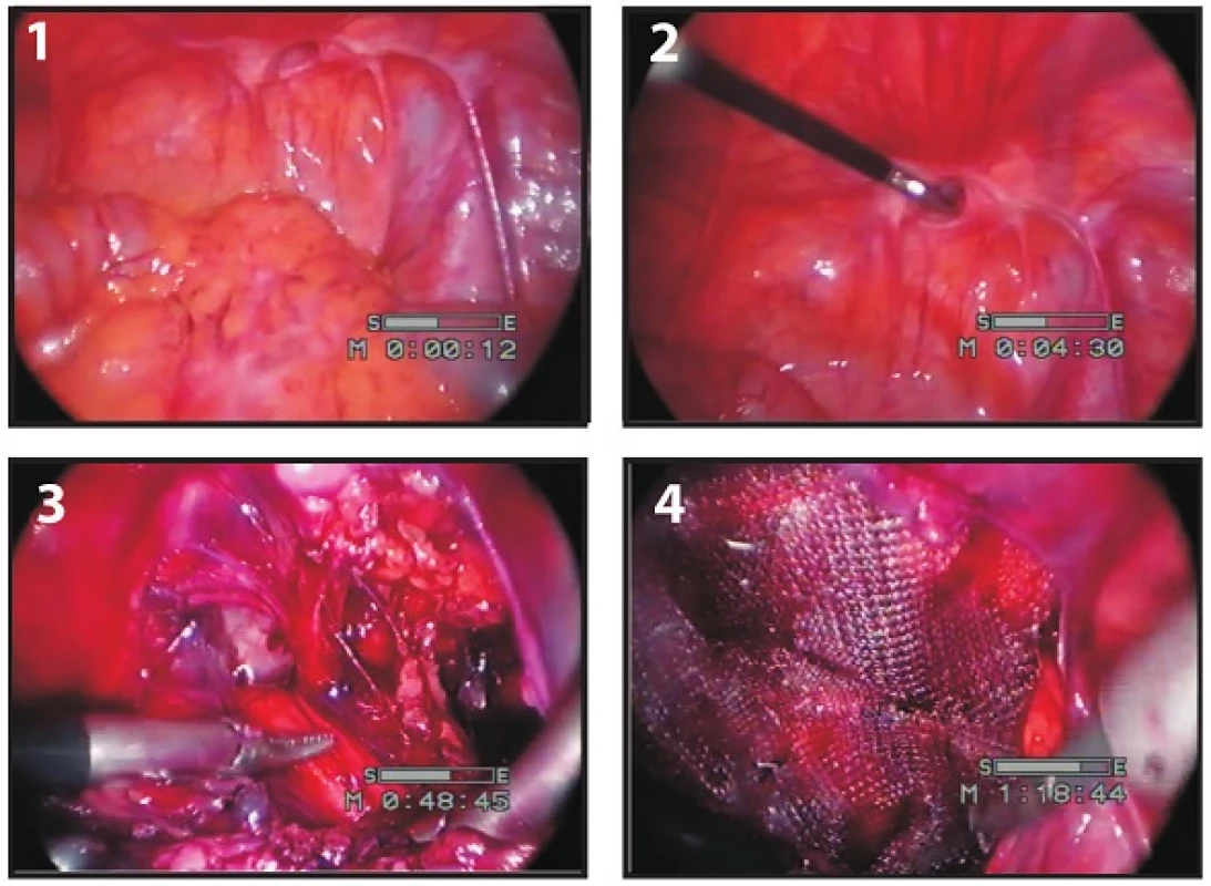 Operace supravezikální kýly – pacient 1
Fig. 1: Hernia supravesicalis surgery – patient 1