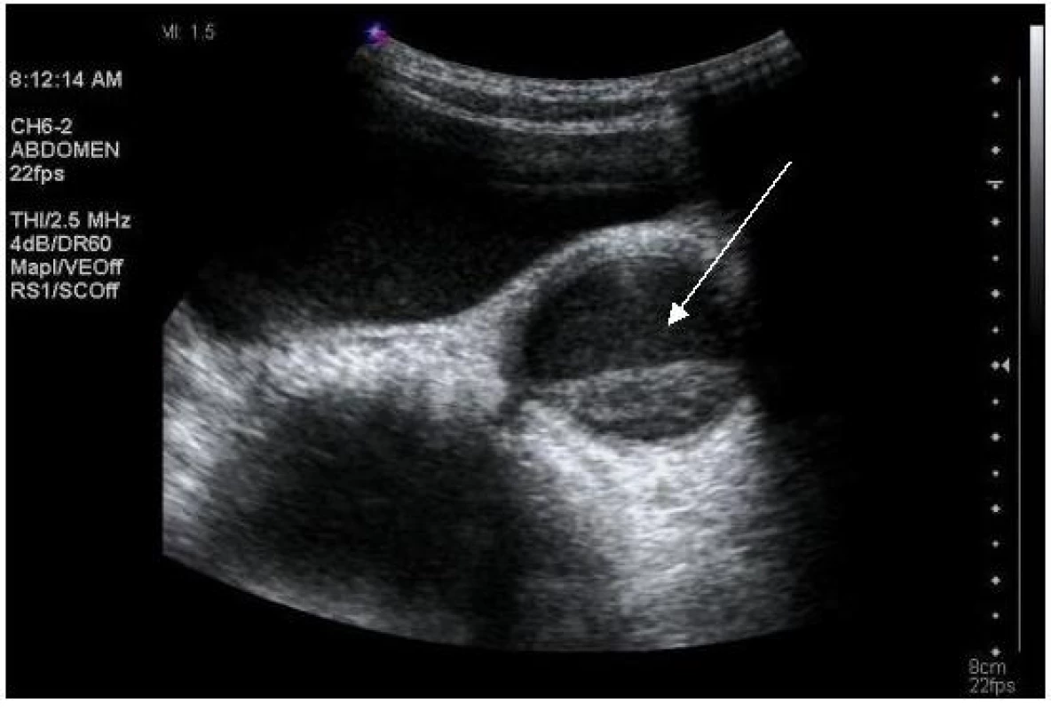 Ultrasonografie, pacient č. 5; šipka ukazuje dilatovaný močovod s abnormální echogenitou jeho náplně.

Fig. 2. Ultrasound, patient No 5; moderate dilation of the ureter with abnormal echogenicity in the lumen (arrow).